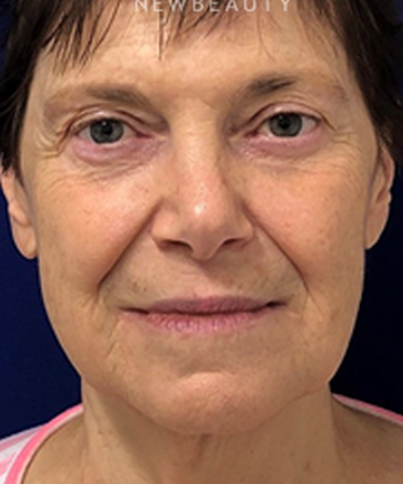 dr-dilip-madnani-facial-rejuvenation-b