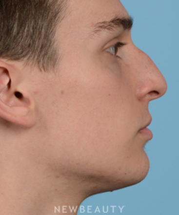 dr-jeffrey-wise-rhinoplasty-b