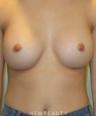 dr-michael-horn-breast-augmentation-b