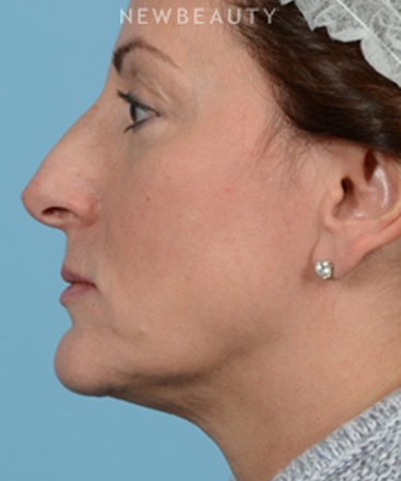 dr-jeffrey-wise-rhinoplasty-b