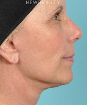 dr-bradley-bengtson-facelift-b