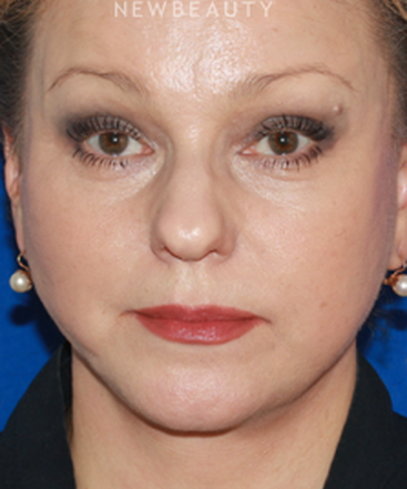 dr-konstantin-vasyukevich-facelift-b