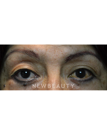 dr-baljeet-purewal-browlift-b