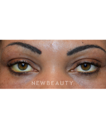 dr-baljeet-purewal-lower-blepharoplasty-b
