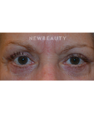 dr-baljeet-k-purewal-blepharoplasties-b