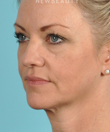 dr-bradley-bengtson-injectables-fillers-b
