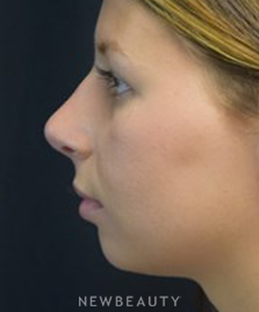 dr-jeffrey-b-wise-rhinoplasty-b
