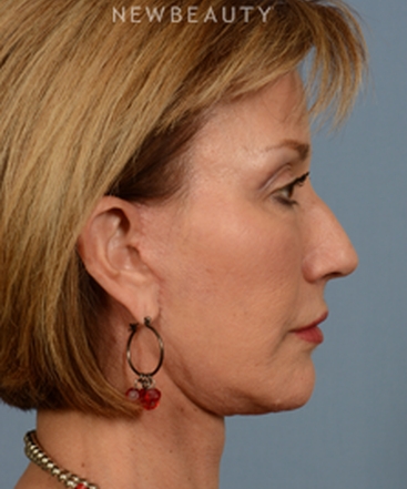 dr-bryan-w-gawley-facial-rejuvenation-b