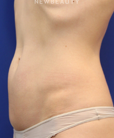 dr-jennifer-levine-emsculpt-b