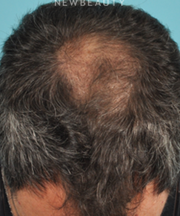 dr-bradley-bengtson-hair-loss-treatment-b