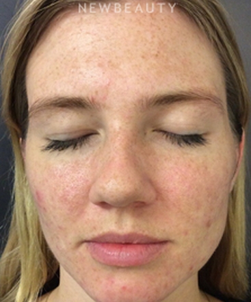 dr-kim-nichols-microneedling-b