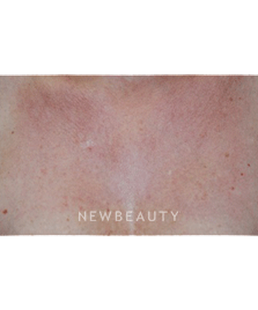 dr-beer-laser-treatment-b