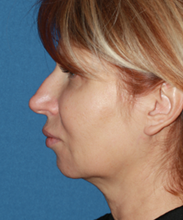 dr-konstantin-vasyukevich-traditional-facelift-b