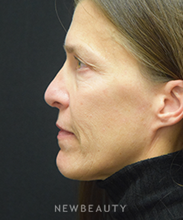 dr-jeffrey-b-wise-rhinoplasty-b