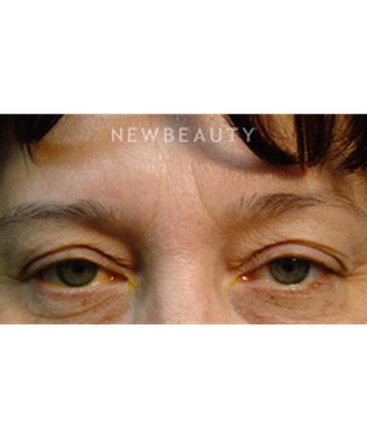dr-baljeet-k-purewal-upper-blepharoplasty-b