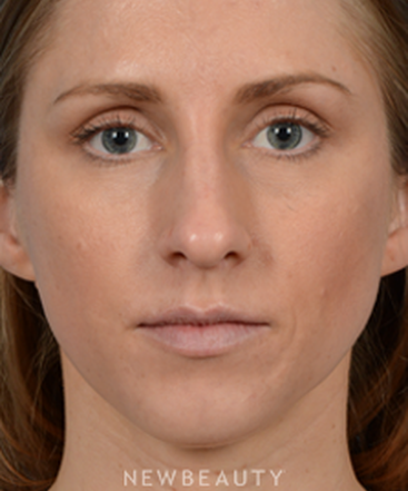 dr-jeffrey-wise-rhinoplasty-b