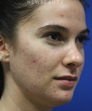 dr-jennifer-levine-lasers-b