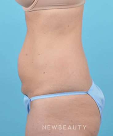 dr-bradley-bengtson-coolsculpting-b