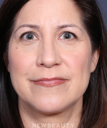 la-jolla-cosmetic-surgery-rhinoplasty-b