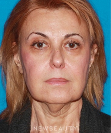 dr-konstantin-vasyukevich-traditional-facelift-b