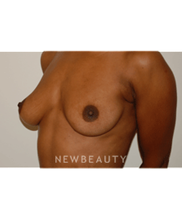 dr-david-rapaport-breast-augmentation-b