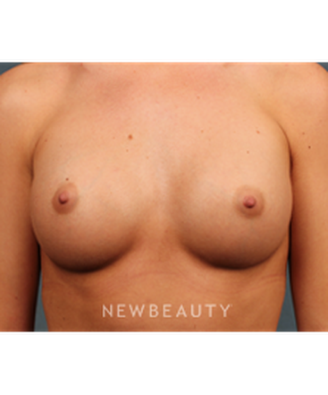 dr-m-bradley-calobrace-breast-augmentation-b