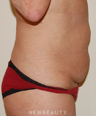 dr-david-rapaport-tummy-tuck-b