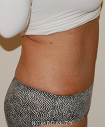 dr-david-rapaport-tummy-tuck-b