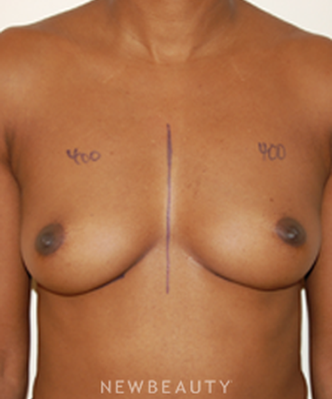dr-david-rapaport-breast-augmentation-b