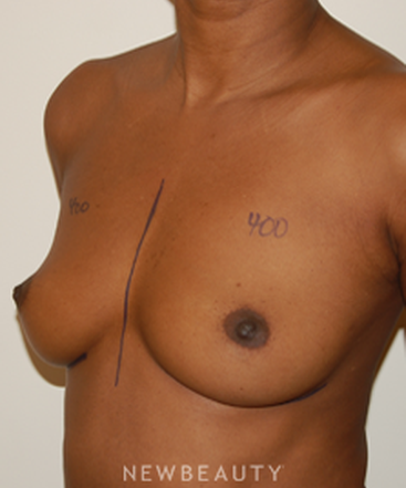 dr-david-rapaport-breast-augmentation-b