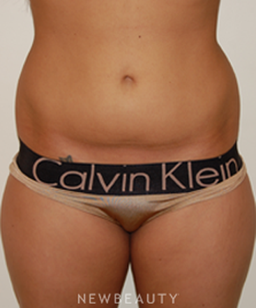 dr-david-rapaport-liposuction-b