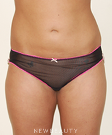 dr-david-rapaport-liposuction-b