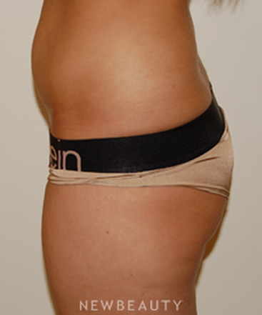 dr-david-rapaport-liposuction-b