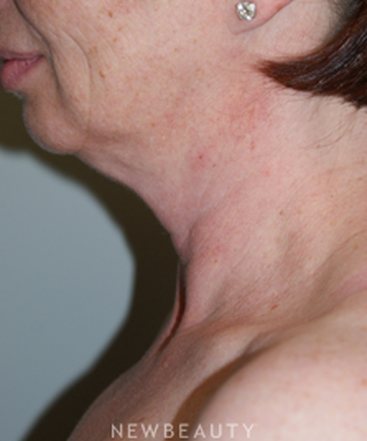 dr-marina-peredo-liposuction-b