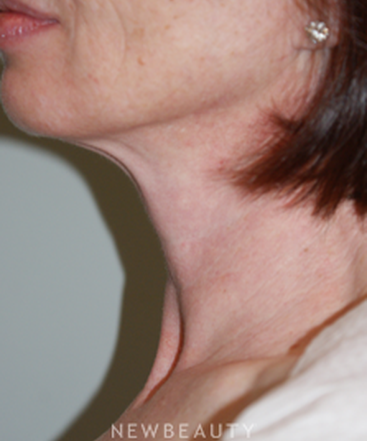 dr-marina-peredo-liposuction-b