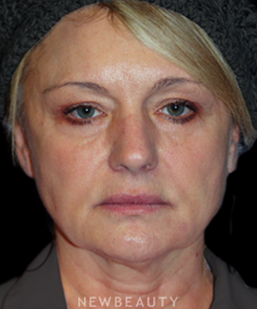 dr-brent-smith-upper-blepharoplasty-necklift-b