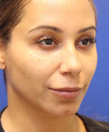 dr-jennifer-levine-liquid-facelift-b
