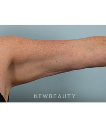dr-kenneth-beer-coolsculpting-b