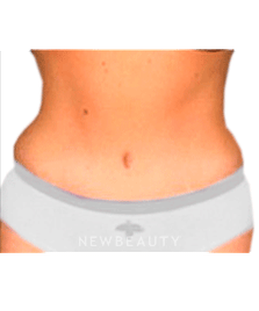 dr-sanjay-grover-tummy-tuck-b