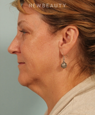 dr-kenneth-beer-kybella-b