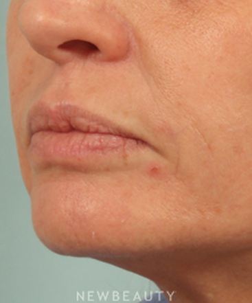dr-kenneth-beer-injectables-fillers-juvederm-b