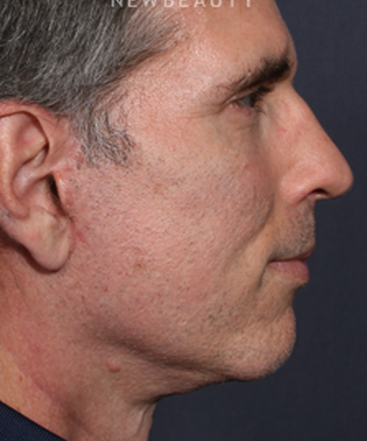 ljcsc-dr-brahme-facelift-b