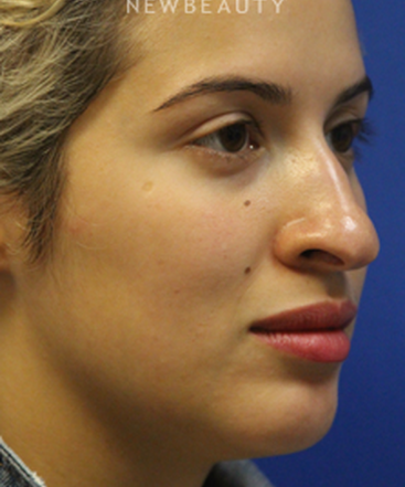 dr-jennifer-levine-rhinoplasty-b