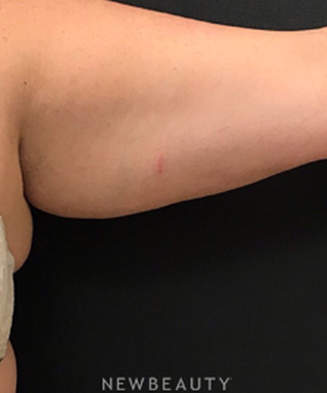 dr-janet-allenby-coolsculpting-b