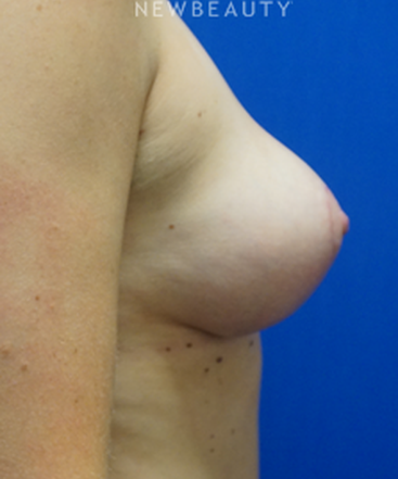 dr-niki-christopoulos-breast-lift-b