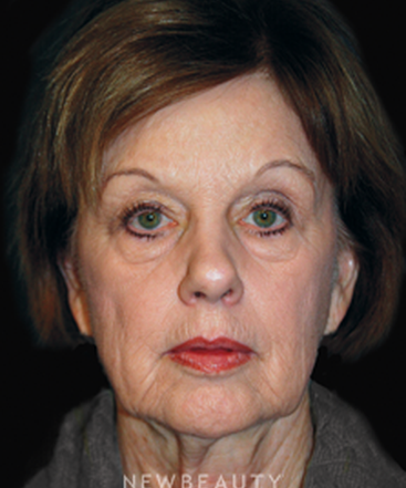 dr-brent-smith-lasers-eye-lift-mini-facelift-b