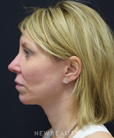 dr-jeffrey-b-wise-facelift-b