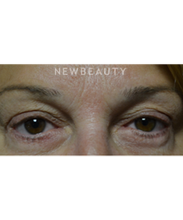 dr-baljeet-k-purewal-blepharoplasty-b