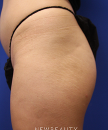 dr-jennifer-levine-sculptra-b