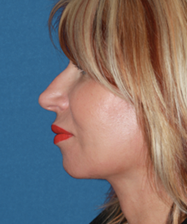 dr-konstantin-vasyukevich-traditional-facelift-b